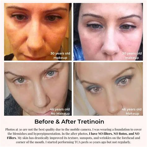 Retin A Tretinoin For Wrinkles Review And Before And After
