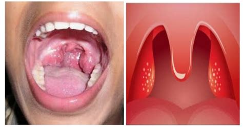 Tonsillitis Causes Symptoms And Treatment