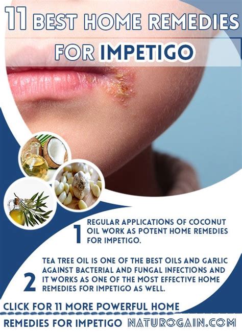 11 Best Home Remedies For Impetigo To Prevent Skin Infection Impetigo
