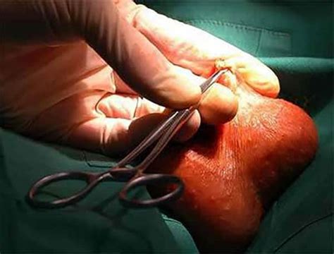 The recovery after a vasectomy is one to two days of rest at home and having an icepack over the scrotal area and normally within a week, a man can resume his normal activities. Dr Tim Nathan Urology | Vasectomy