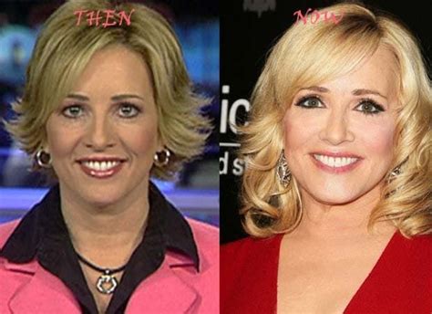 Dana Perino Before And After Plastic Surgery