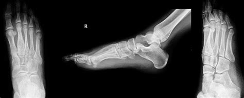 Metatarsal Aneurysmal Bone Cyst A Cause Of Long Lasting Foot Pain In