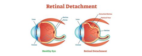 Retinal Detachment Causes Types And Diagnosis