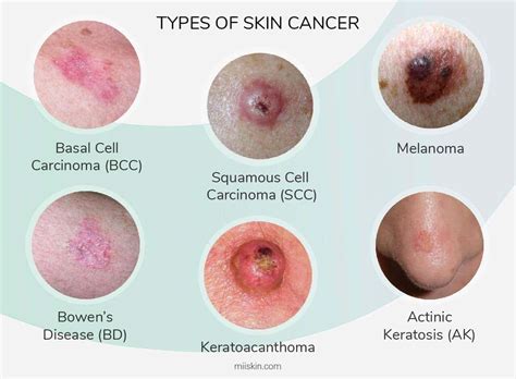 Skin Cancer On Face Early Signs