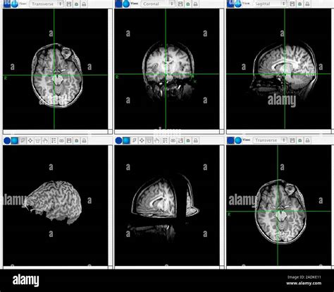 Brain Mapping Scans Screen Grab Of Magnetic Resonance Imaging Mri