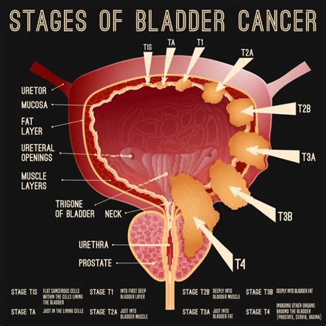 Symptoms And Diagnosis Of Bladder Cancer Tabitomo