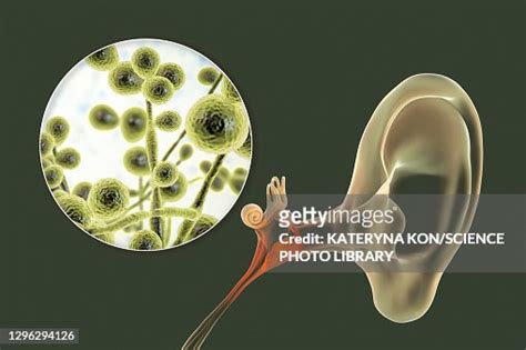 Chronic Fungal Otitis Media Ear Infection Illustration Stock