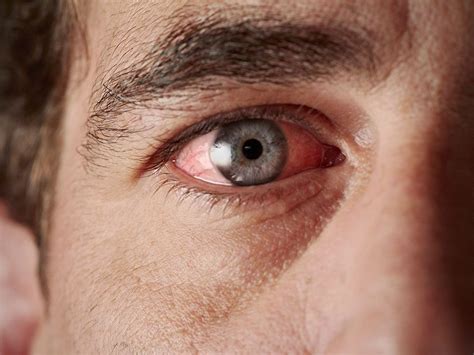Quick Tips For Dealing With Tired Irritated Eyes