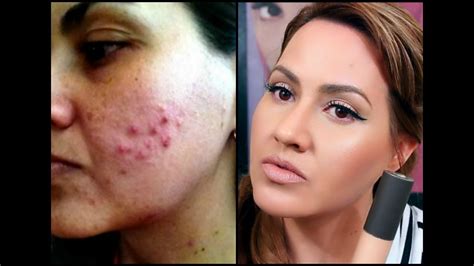 How To Get Rid Of Acne Scarring And Dark Spots Youtube