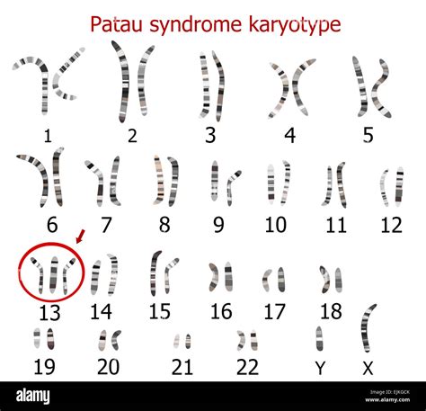 Pätau Syndrom Karyotyp Trisomie 13 Stockfotografie Alamy