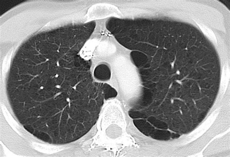 Paraseptal Emphysema Radrounds Radiology Network