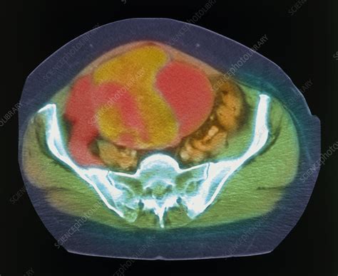 Ovarian Cancer Ct Scan Stock Image M8500369 Science Photo Library
