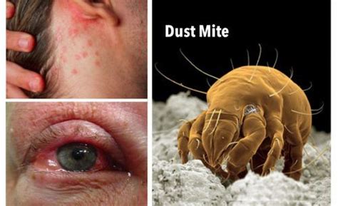 Dust Mite Infections Are Found In 4 Out Of 5 Homes Kill Them With This