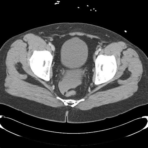 Liver Laceration Radiology Case