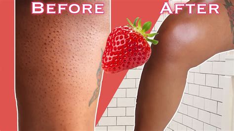 How To Get Rid Of Strawberry Legs In One Day Youtube