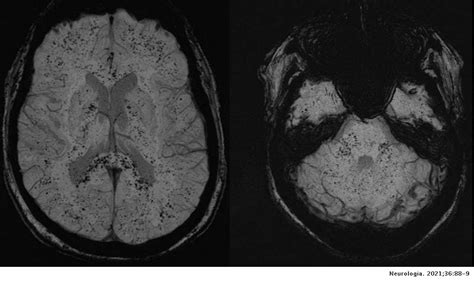 Multiple Cerebral Microbleeds Associated With Disseminated