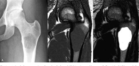 Figure 1 From Fracture Risk In Unicameral Bone Cyst Is Magnetic