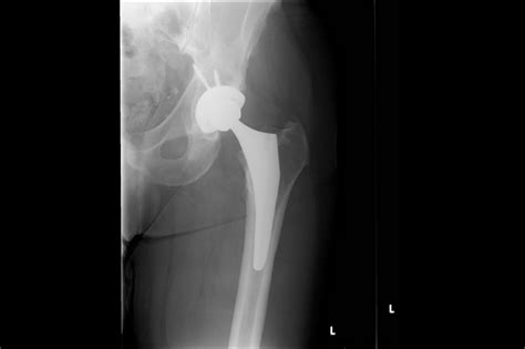Thigh Pain 2 Years After Hip Replacement Surgery Clinical Pain Advisor
