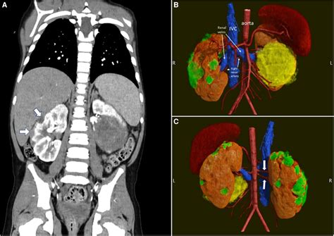 Pre Operative Imaging Of A Case Of Synchronous Bilateral Wilms Tumor