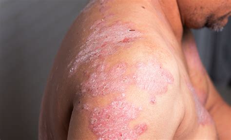 A Patient Centered Approach To Psoriasis Treatment