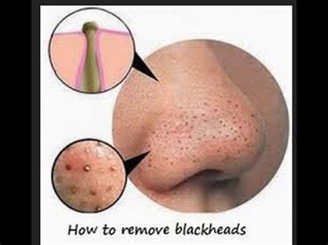 Find the best blackhead removers for nose based on what customers said. DIY BLACKHEAD REMOVAL - YouTube