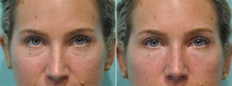 Injections Tear Trough Under Eye Injections Photos Chevy Chase Md Patient 12159