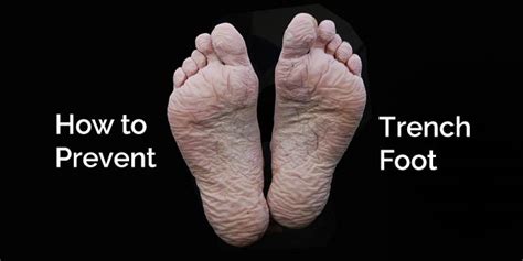 How To Prevent Trench Foot 5 Tips For Protecting Your Feet Prevention Trench Feet