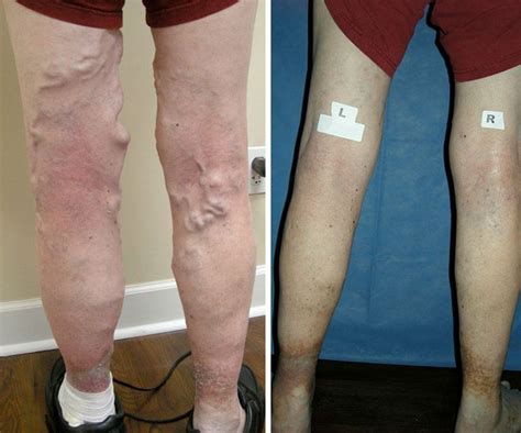 Effective And Affordable Jacksonville Vein Treatment Before And After