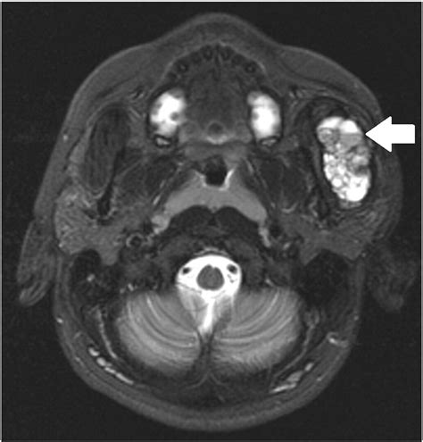 Aneurysmal Bone Cyst Of The Zygomatic Arch A Case Report Clinical