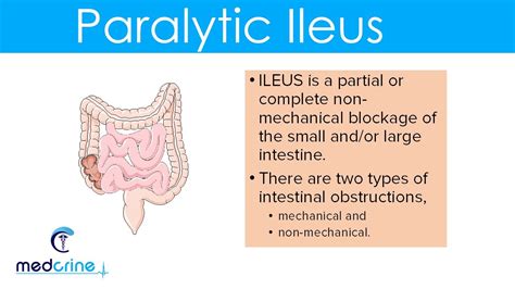 Paralytic Ileus Causes Pathophysiology Clinical Features Diagnosis And Treatment Youtube