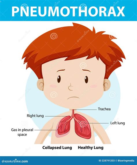 Tension Pneumothorax Poster Cartoon Vector Cartoondealer The Best Porn Website