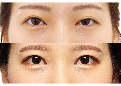 Ptosis Correction Double Eyelid Surgery In Korea Центр Пластической