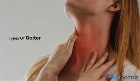 Types Of Goiter Causes Symptoms And Treatment
