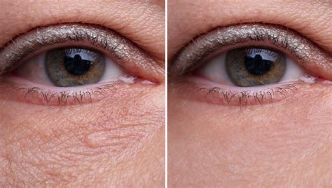 Details Under Eye Bags And Wrinkles In Duhocakina