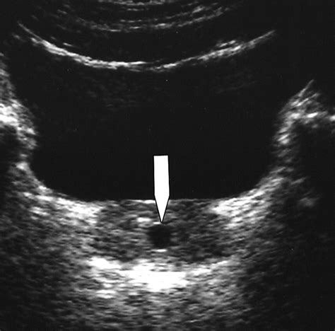 Midline Prostatic Cysts In Healthy Men Incidence And Transabdominal