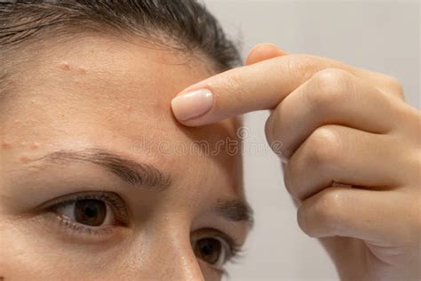 Close Up Portrait Of A Girl Squeezes Out A Pimple On Her Forehead An