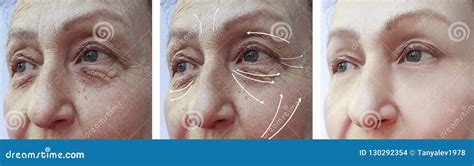 Face Elderly Woman Wrinkles Effect Filler Difference Patient