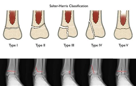 Ankle Fractures In Children Orthoinfo Aaos