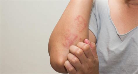 Lupus Skin Rash Symptoms And Treatment