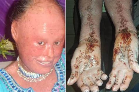 Woman Who Suffers With Rare Dry Flaky Skin Condition Called Harlequin