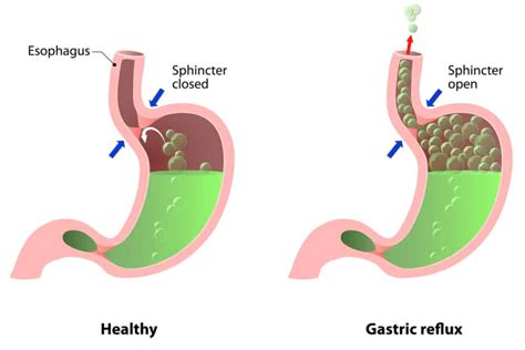 Lower Esophageal Sphincter Dysfunction Everything You Need To Know