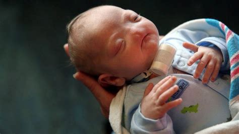 Meet Miracle Baby Born Without Nose And Breaths Perfectly Photos