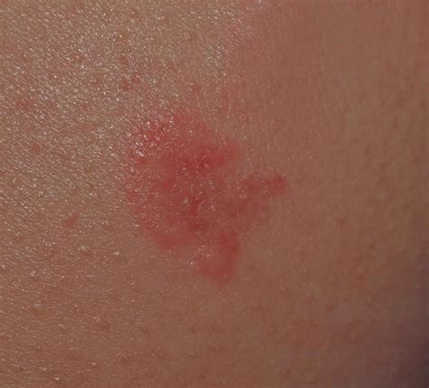 Bumps On Skin That Look Like Blisters