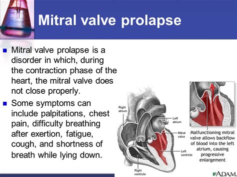 Mitral Valve Prolapse Images Mitral Valve Prolapse And Regurgitation