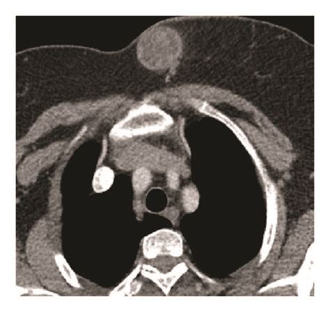 Axial Contrast Enhanced Thorax Ct Image Hypodense Well Defined Mass