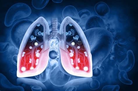 Virus And Bacteria Infected The Human Lungs Lung Disease Stock