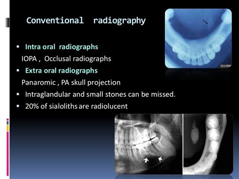 Sialolithiasis And Its Management In Oral And Maxillofacial Surgery