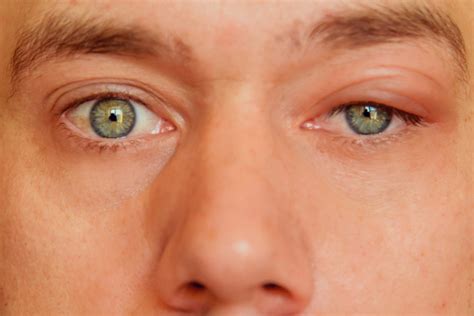 Understanding Boils And Styes Causes Symptoms And Treatments
