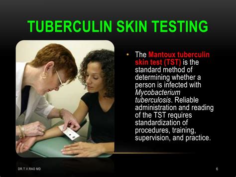 PPT Tuberculin Skin Testing Mantoux Tuberculin Skin Test PowerPoint