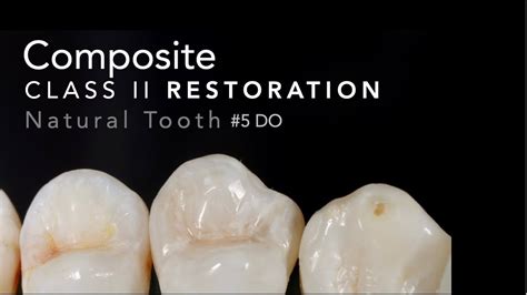 Class Ii Composite Restoration 5 Do Natural Tooth Youtube